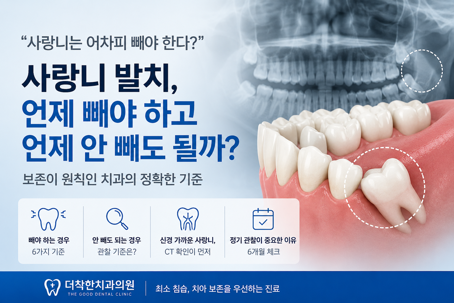 "사랑니는 어차피 빼야 한다"는 말, 절반만 맞습니다