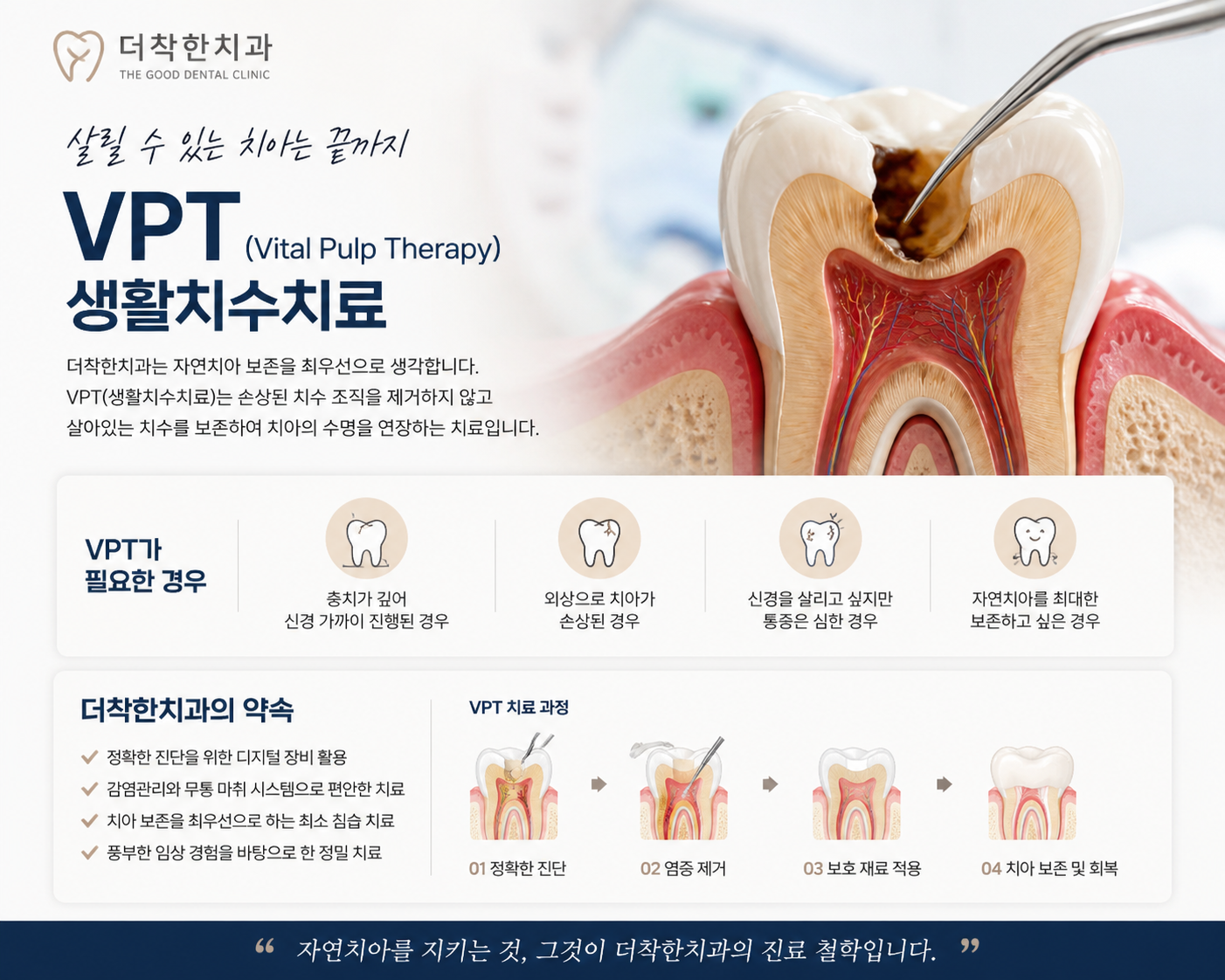 신경치료 전에 치아를 살리는 마지막 기회]