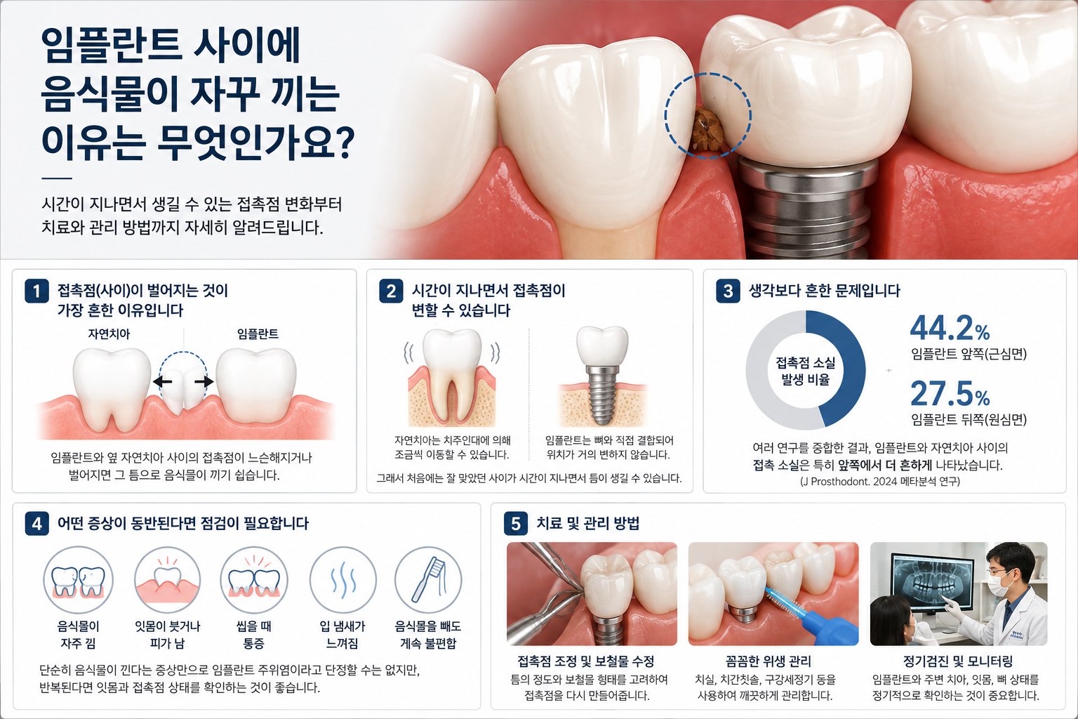 임플란트 사이에 음식물이 자꾸 끼는 이유는 무엇인가요?