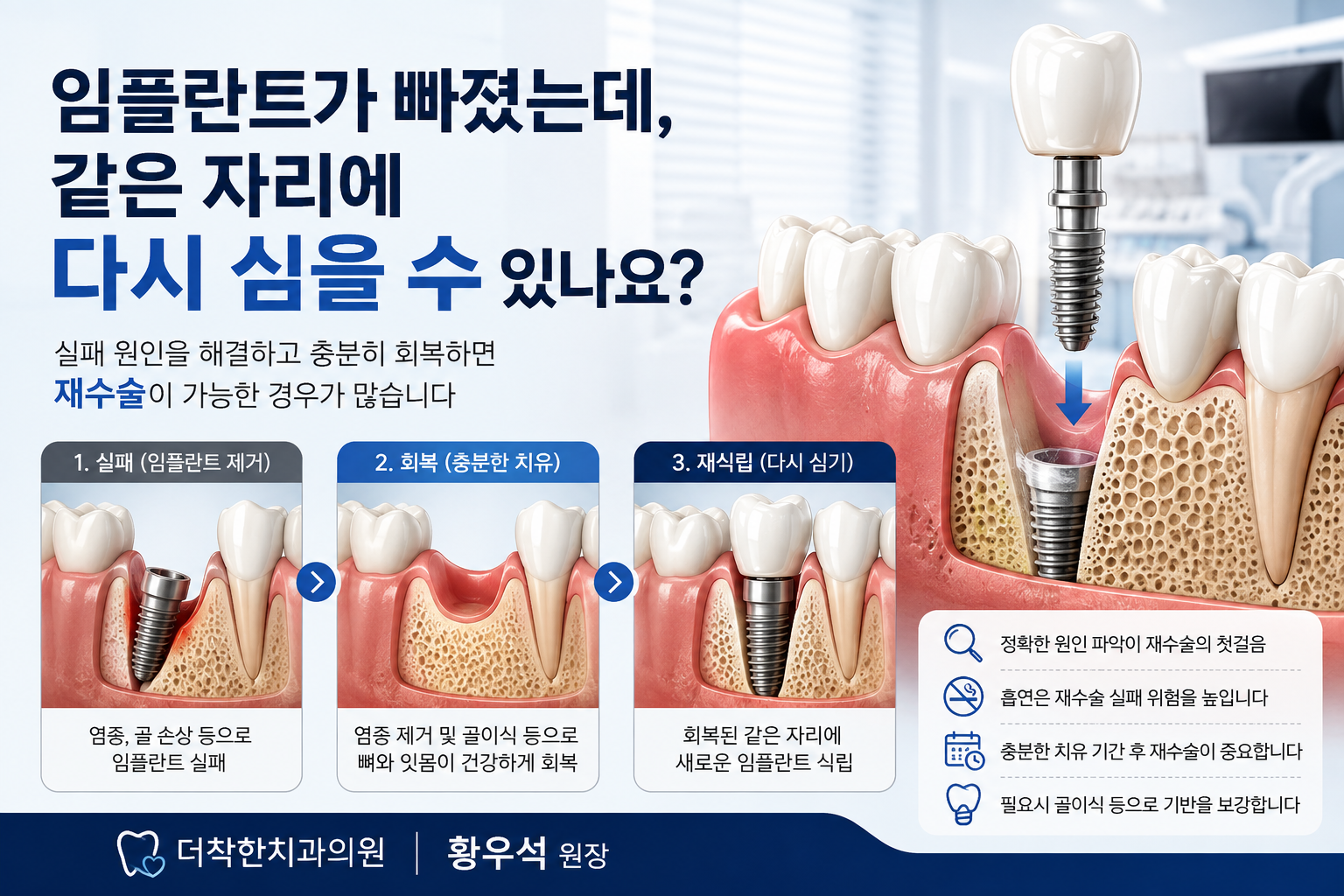 임플란트 실패 후 제거된 부위가 충분히 치유된 뒤 같은 자리에 새로운 임플란트를 다시 식립하는 과정을 보여주는 의료 인포그래픽. 임플란트 재수술과 재식립의 실패·회복·다시 심기 과정을 3단계로 설명한 더착한치과의원 안내 이미지.