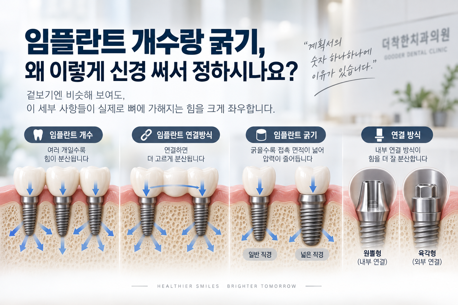 임플란트 개수와 굵기, 연결 방식에 따라 씹는 힘이 주변 뼈에 어떻게 분산되는지 비교한 임플란트 하중 분산 설명 이미지. 여러 개의 임플란트, 연결 보철, 임플란트 직경, 내부·외부 연결 방식의 차이를 치조골 단면과 화살표로 보여준다.