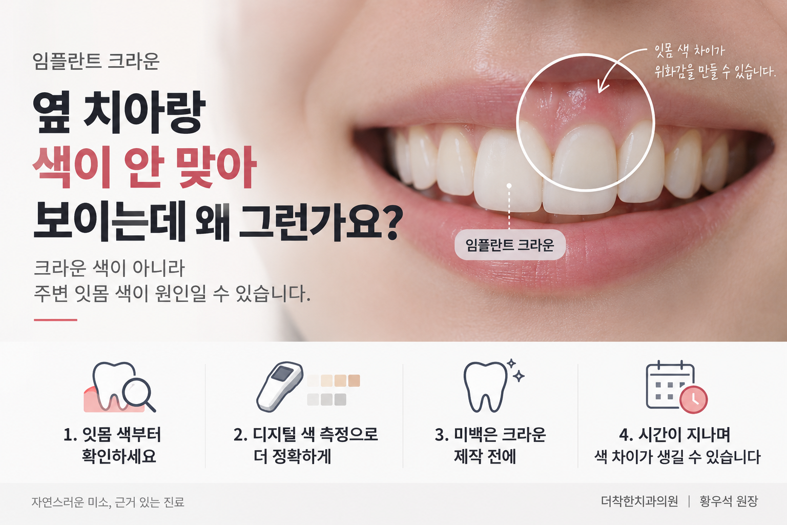 임플란트 크라운이 옆 자연치아와 색이 달라 보이는 모습을 보여주는 이미지. 앞니 임플란트 주변 잇몸 색 차이를 강조해, 크라운 자체보다 잇몸 색이 위화감의 원인일 수 있음을 설명합니다.