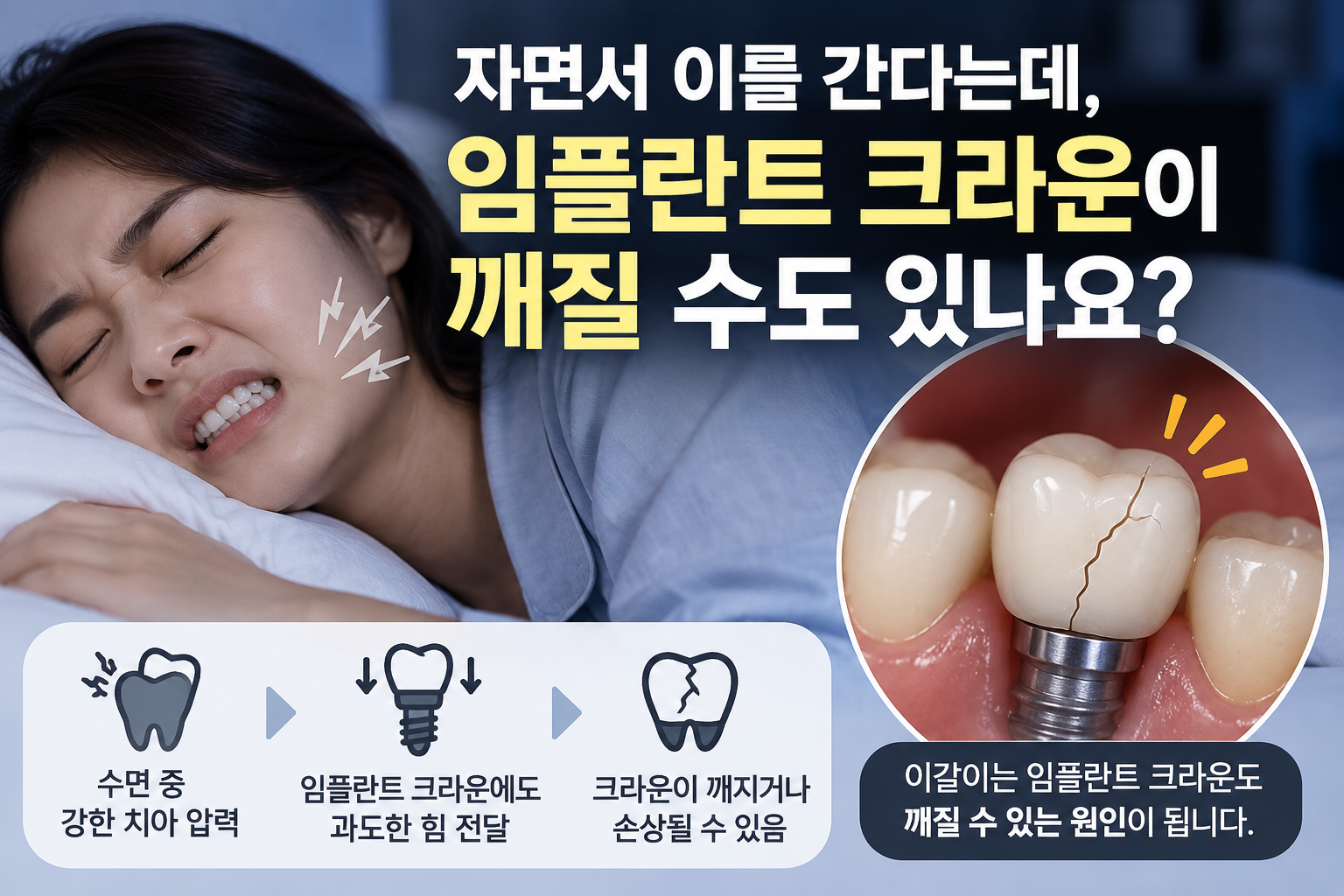 자면서 이를 가는 수면 이갈이로 강한 치아 압력이 반복되면 임플란트 크라운에 과도한 힘이 전달되어 크라운이 깨지거나 손상될 수 있음을 설명하는 이미지. 왼쪽에는 이를 갈며 자는 여성, 오른쪽에는 균열이 생긴 임플란트 크라운 확대 모습이 보인다.