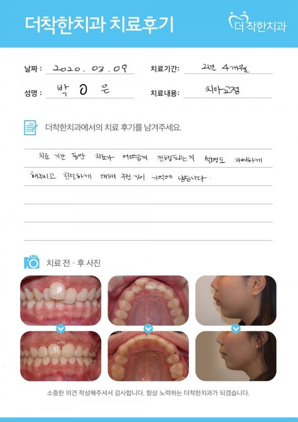 “자세한 설명과 친절한 진료가 기억에 남아요” 2년 4개월 치아교정 후기