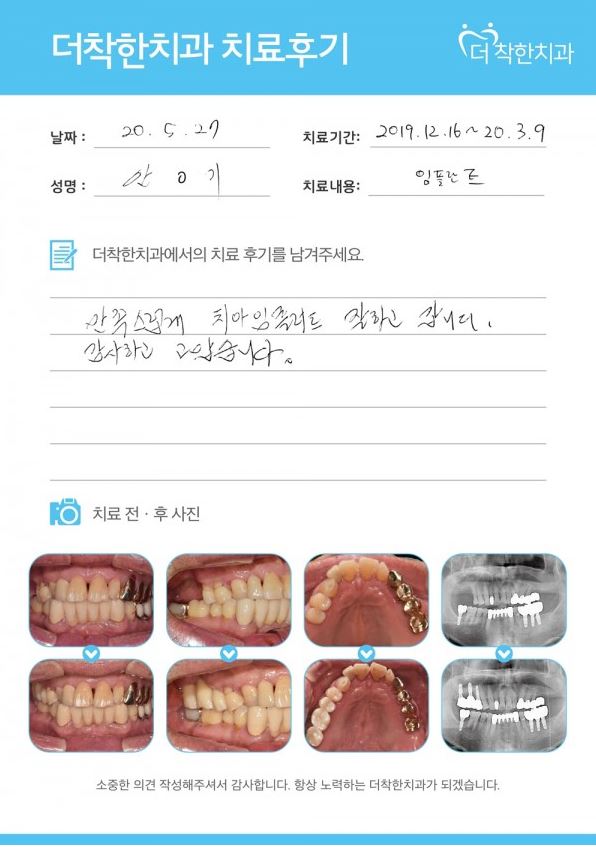 임플란트 치료 전후 모습, 환자분의 실제 치료 후기