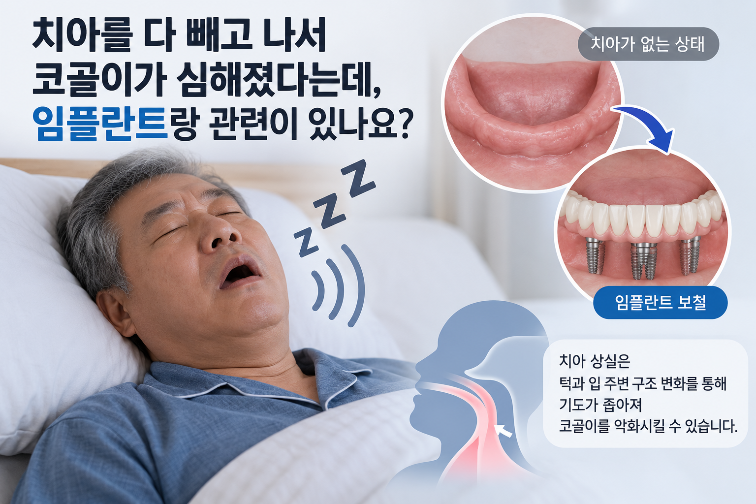 치아를 모두 상실한 뒤 코골이가 심해진 중년 남성의 수면 모습과, 무치악 상태·임플란트 보철·상기도 변화를 비교해 치아 상실과 코골이의 관련성을 설명하는 이미지.
