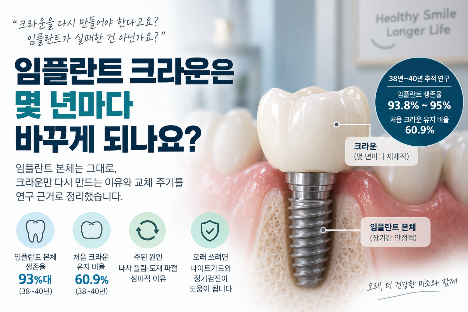 임플란트는 잇몸뼈 안에 심어진 본체와 그 위에 올라가는 크라운의 수명이 서로 다릅니다. 장기 추적 연구에서는 임플란트 본체는 수십 년 동안 높은 생존율을 보였지만, 처음 제작한 크라운은 사용 중 나사 풀림, 도재 파절, 마모, 심미적인 변화 등으로 다시 제작하는 경우가 적지 않았습니다. 크라운을 교체한다고 해서 임플란트 자체가 실패한 것은 아니며, 본체가 건강하다면 그대로 유지한 채 크라운만 새로 제작할 수 있습니다. 정기검진과 이갈이 관리가 크라운을 오래 사용하는 데 도움이 됩니다.