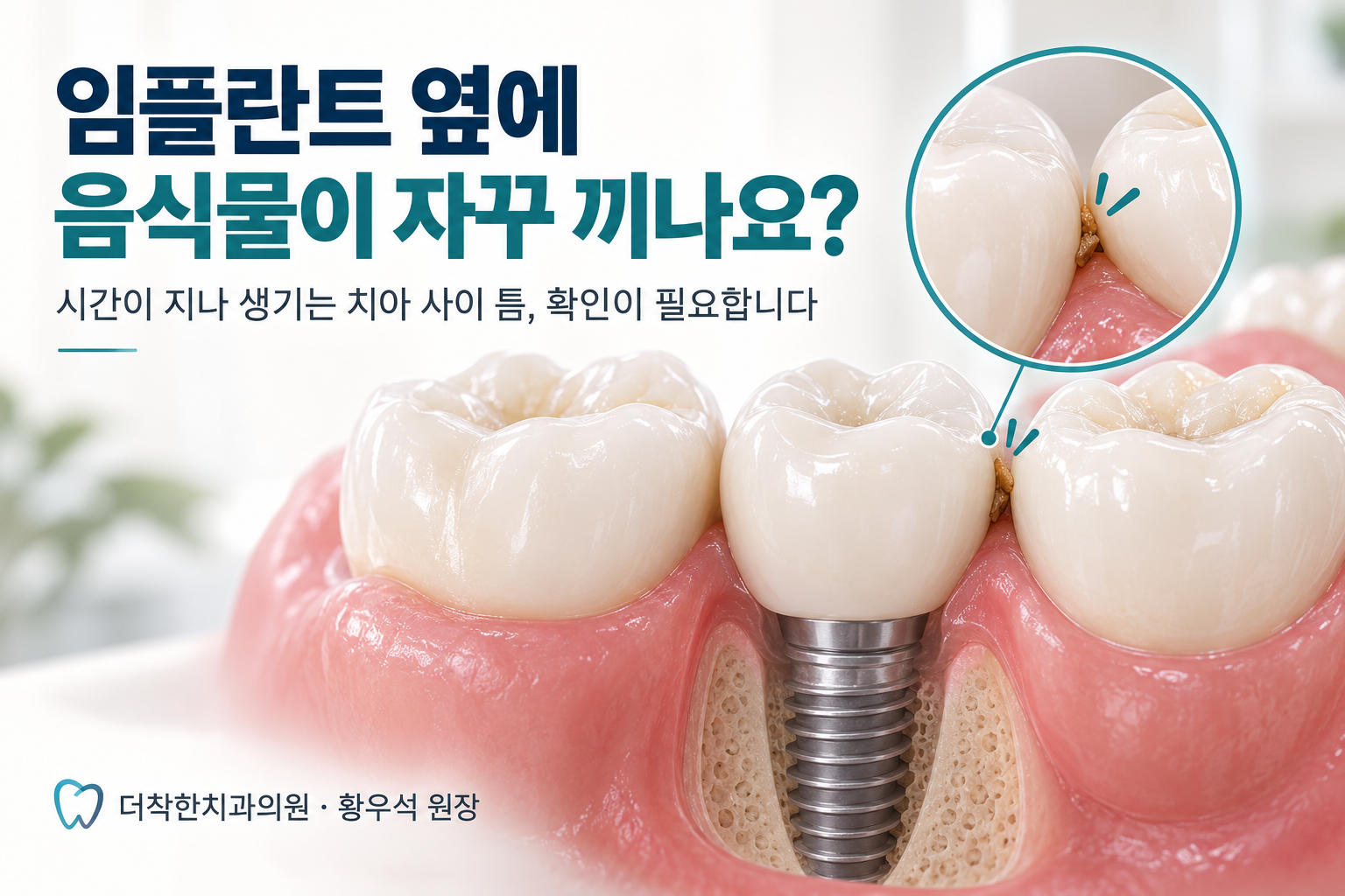 임플란트 크라운과 옆 자연치아 사이의 틈에 음식물이 낀 모습을 확대해 보여주는 치아 모형 이미지
