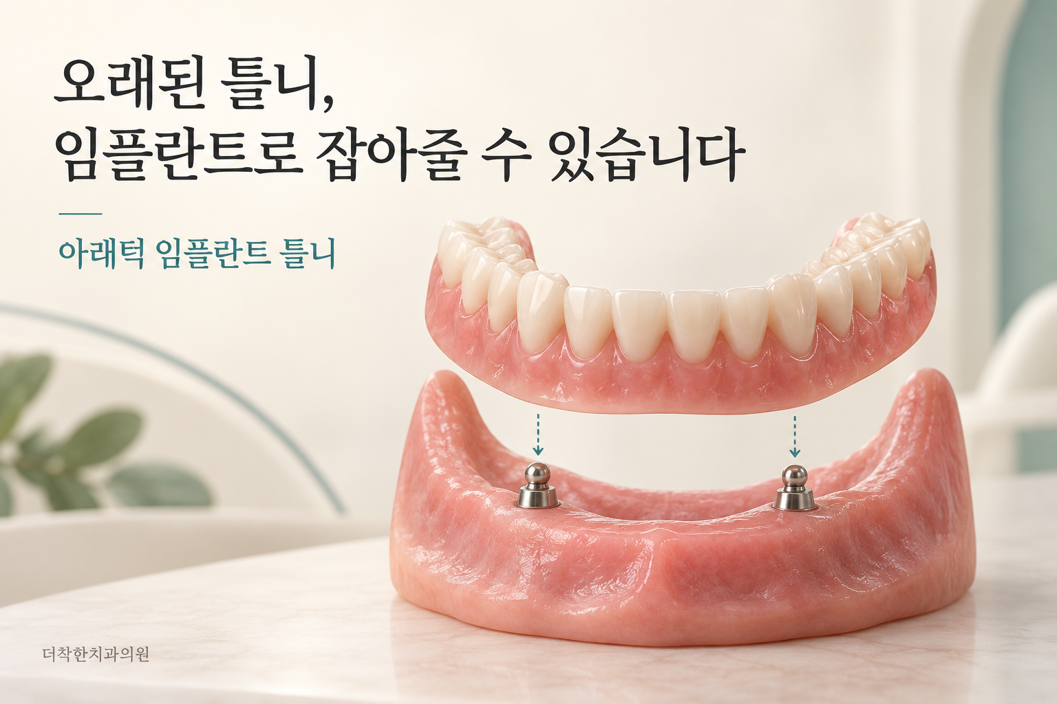 아래턱에 심은 두 개의 임플란트가 탈착식 틀니를 고정하는 원리를 보여주는 모형 이미지.