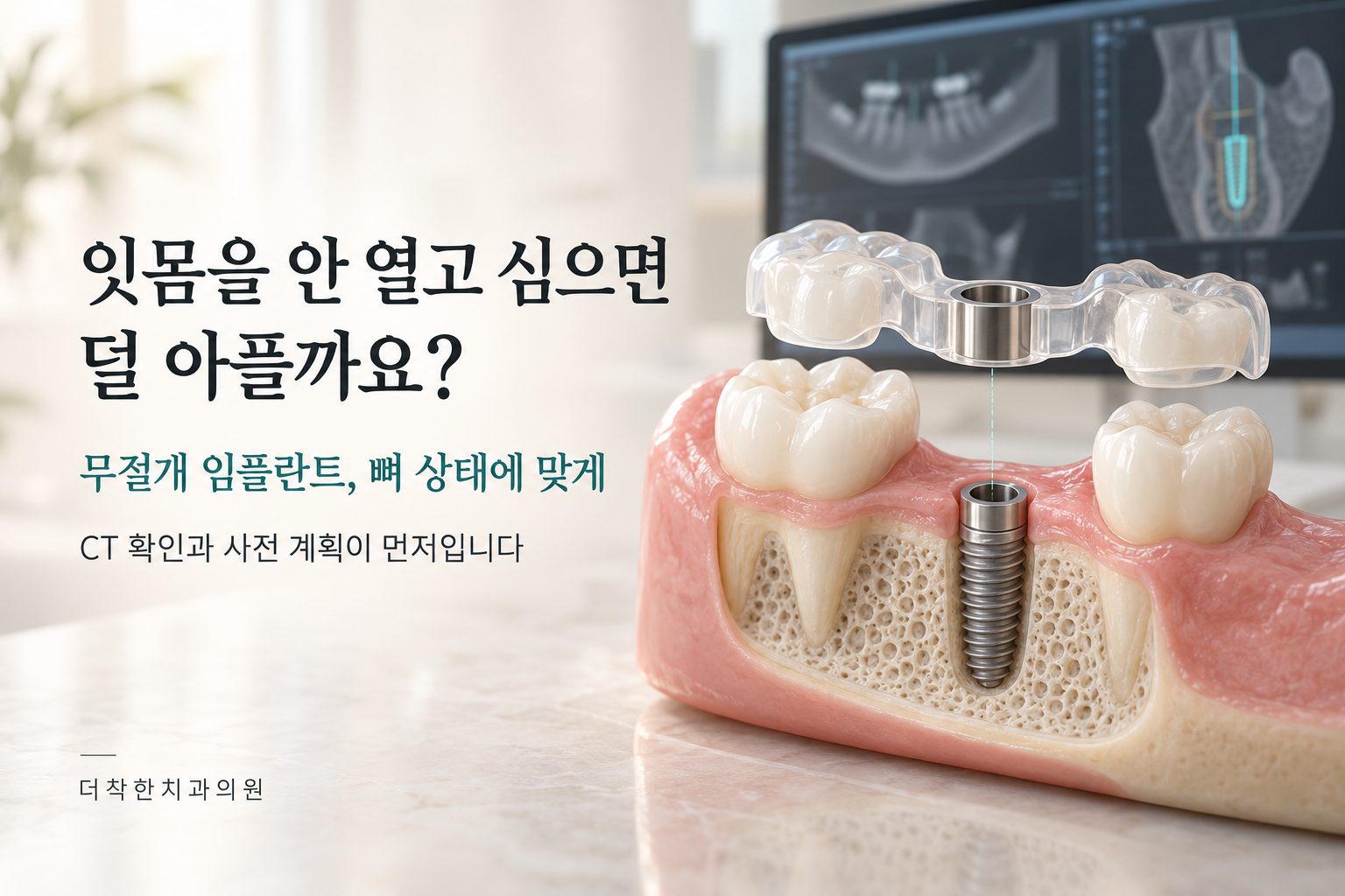 alt: CT 영상과 수술 가이드, 임플란트 단면 모형으로 무절개 식립 방식과 사전 계획의 중요성을 보여주는 이미지.